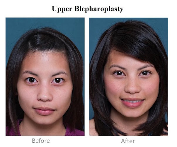 most_popular_cosmetic_surgery_procedures_in_the_hilippines_04