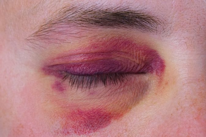 Image result for bruises