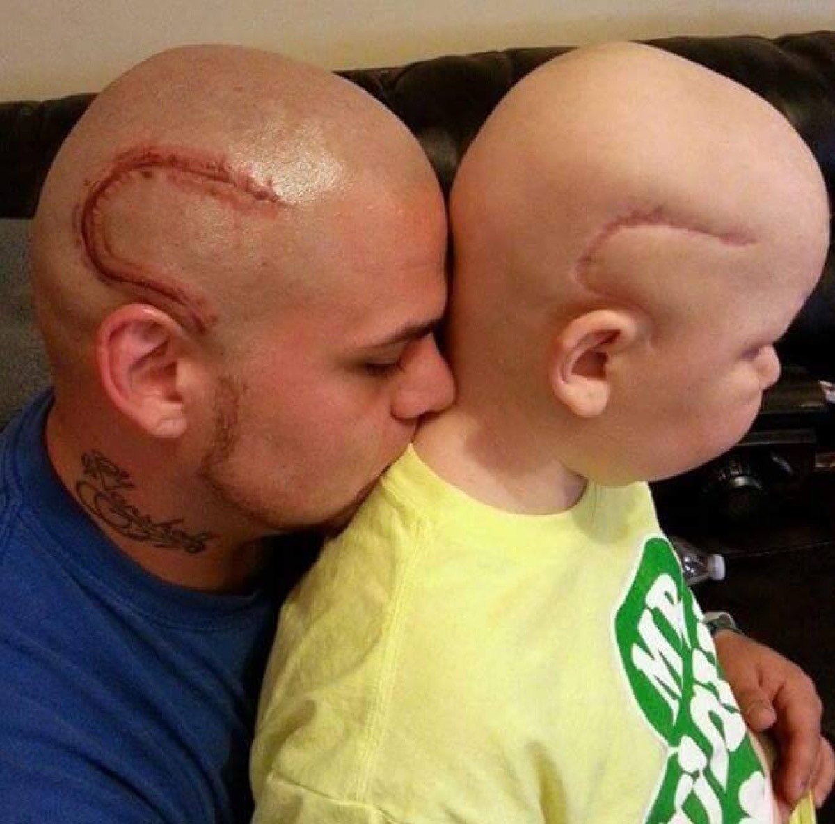 boy with bald head and scar on skull and dad with matching tattoo