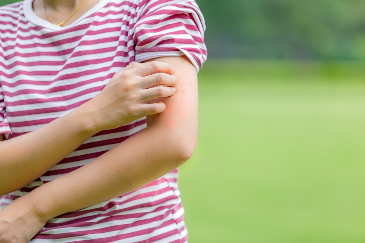 Woman itching mosquito bites